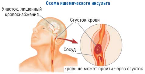 Чем вылечить грибок на ногтях пальцев ног